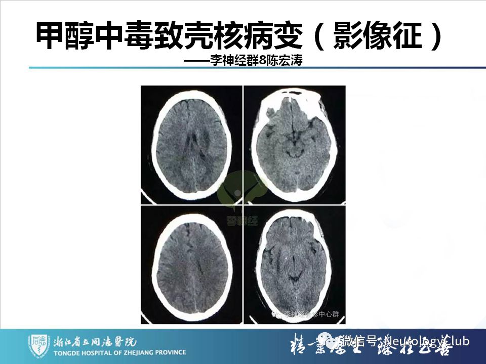 影像PPT - 【PPT】双侧基底节病变的影像诊断和鉴别诊断-31