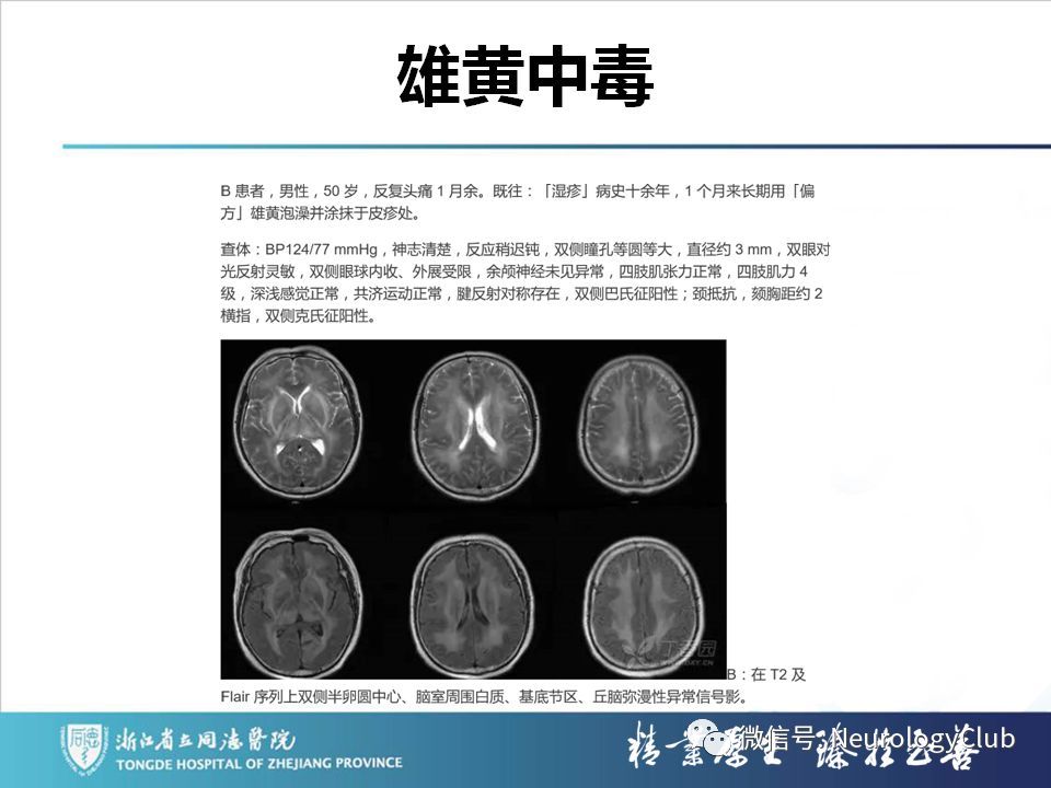 影像PPT - 【PPT】双侧基底节病变的影像诊断和鉴别诊断-32