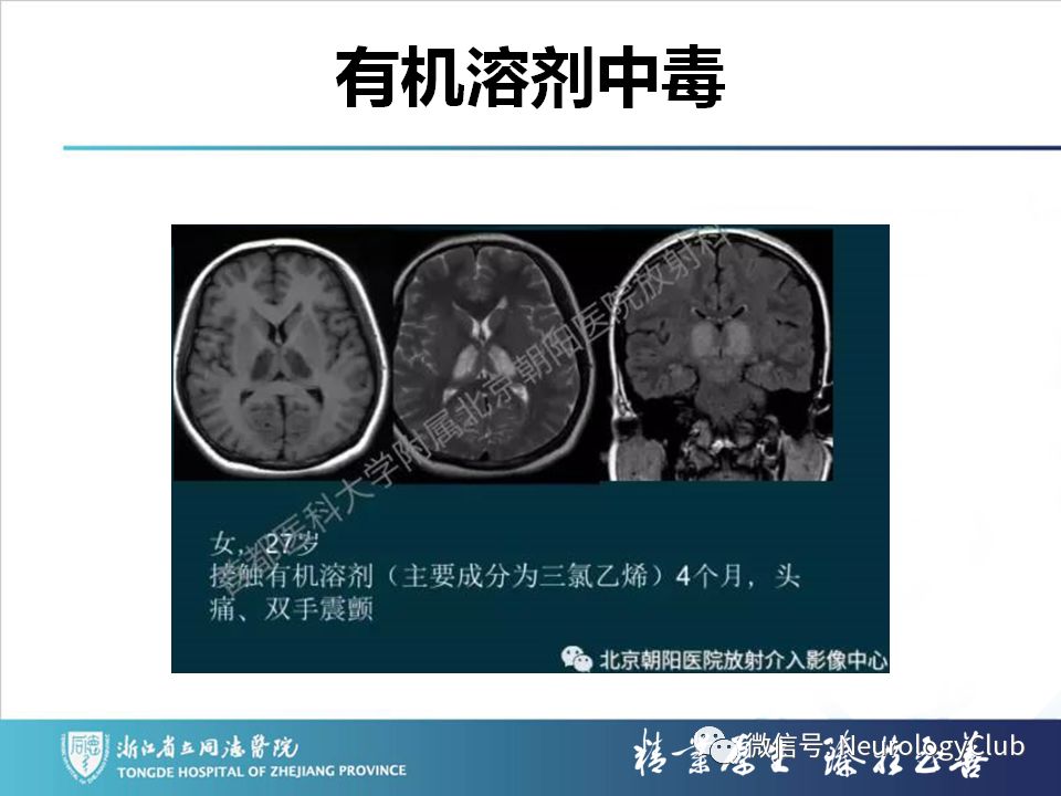 影像PPT - 【PPT】双侧基底节病变的影像诊断和鉴别诊断-33
