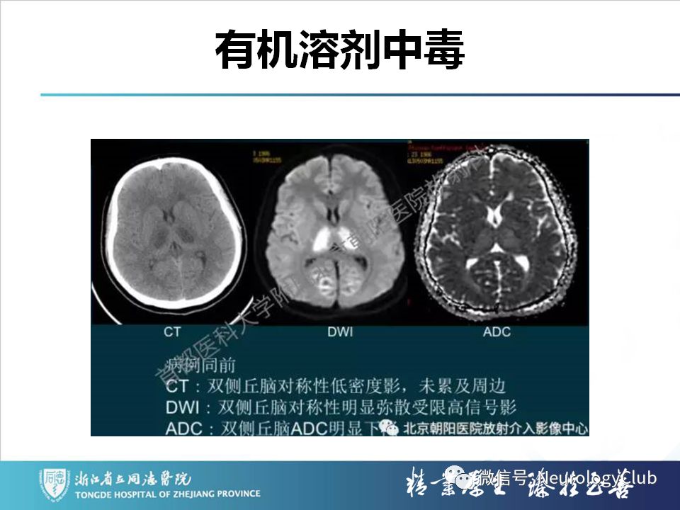 影像PPT - 【PPT】双侧基底节病变的影像诊断和鉴别诊断-34