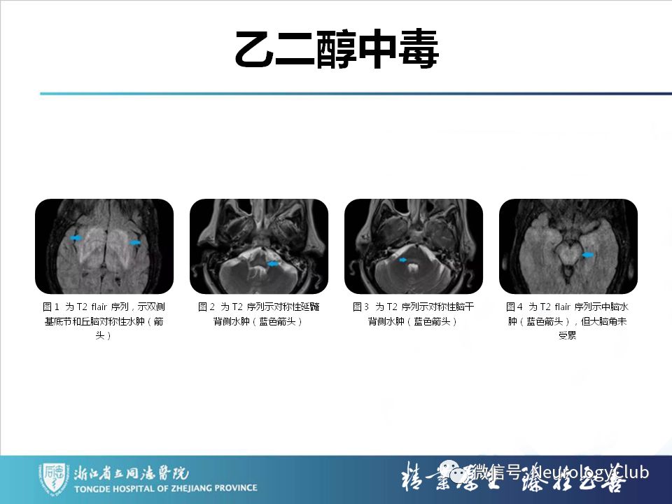 影像PPT - 【PPT】双侧基底节病变的影像诊断和鉴别诊断-36