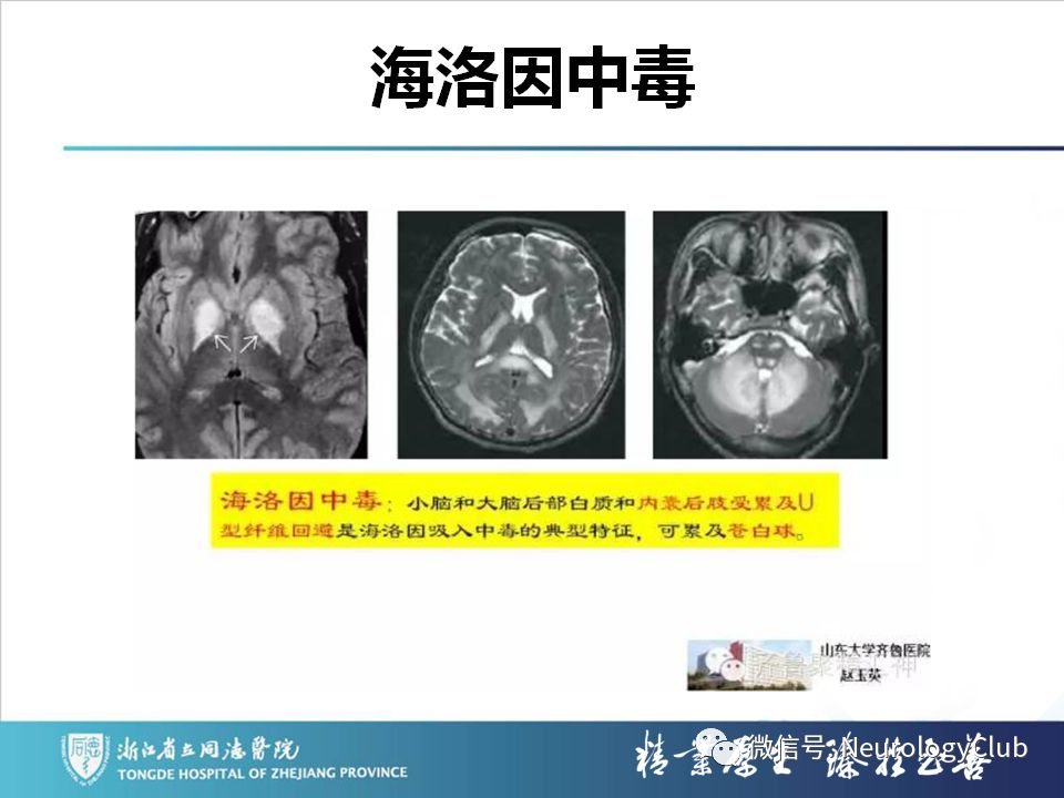 影像PPT - 【PPT】双侧基底节病变的影像诊断和鉴别诊断-37