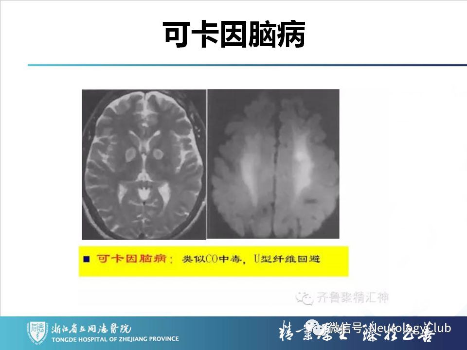 影像PPT - 【PPT】双侧基底节病变的影像诊断和鉴别诊断-38