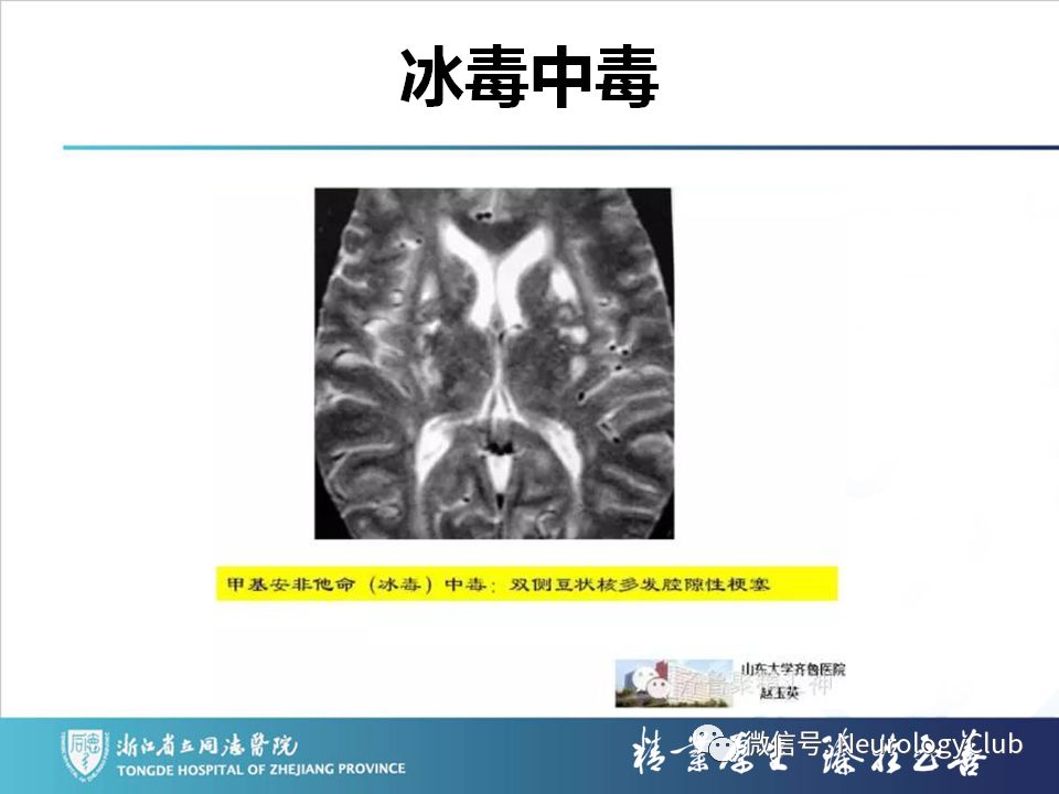 影像PPT - 【PPT】双侧基底节病变的影像诊断和鉴别诊断-39