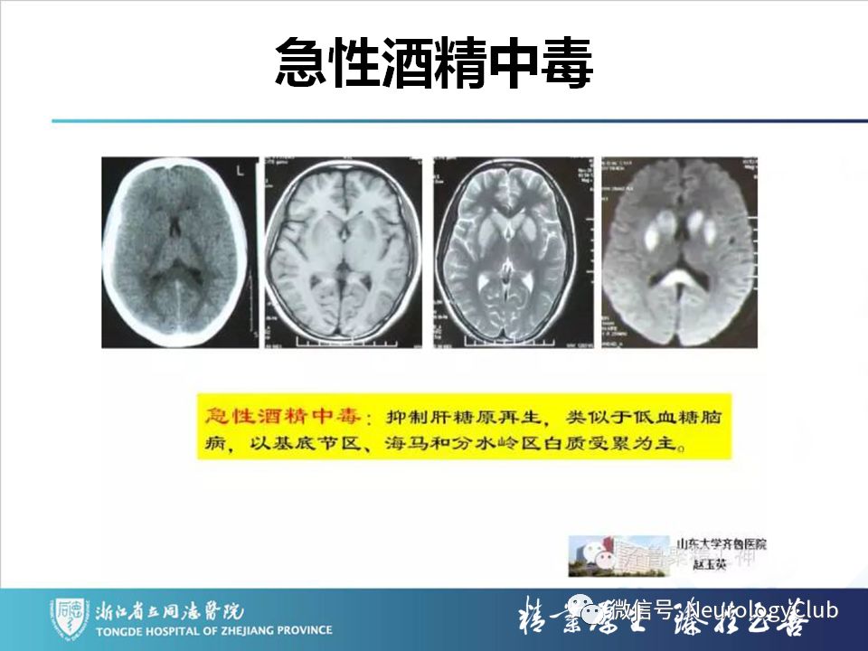 影像PPT - 【PPT】双侧基底节病变的影像诊断和鉴别诊断-41