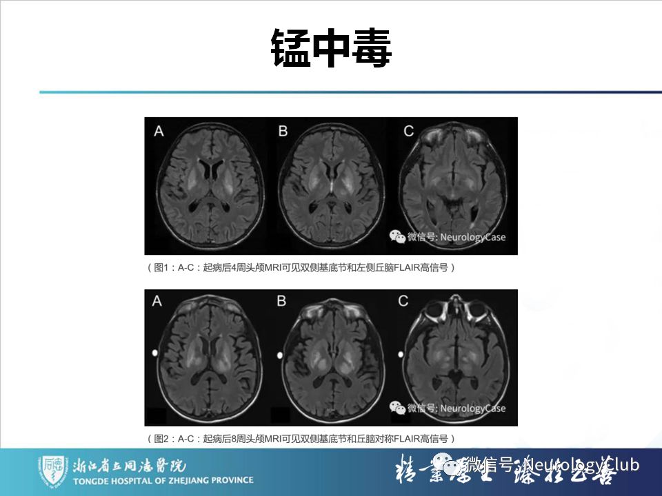 影像PPT - 【PPT】双侧基底节病变的影像诊断和鉴别诊断-43