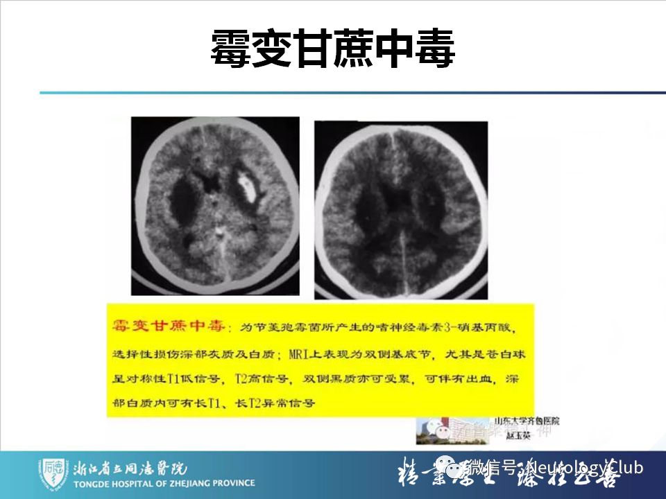影像PPT - 【PPT】双侧基底节病变的影像诊断和鉴别诊断-40