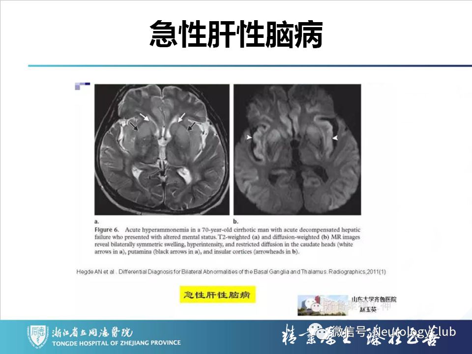 影像PPT - 【PPT】双侧基底节病变的影像诊断和鉴别诊断-46
