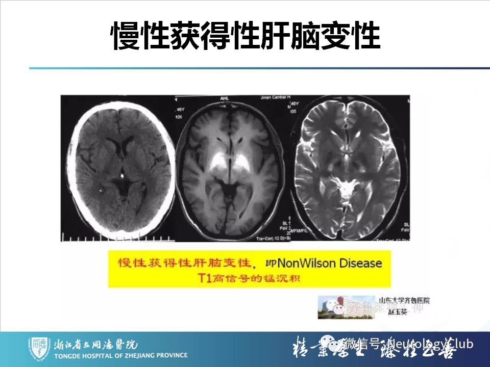 影像PPT - 【PPT】双侧基底节病变的影像诊断和鉴别诊断-47