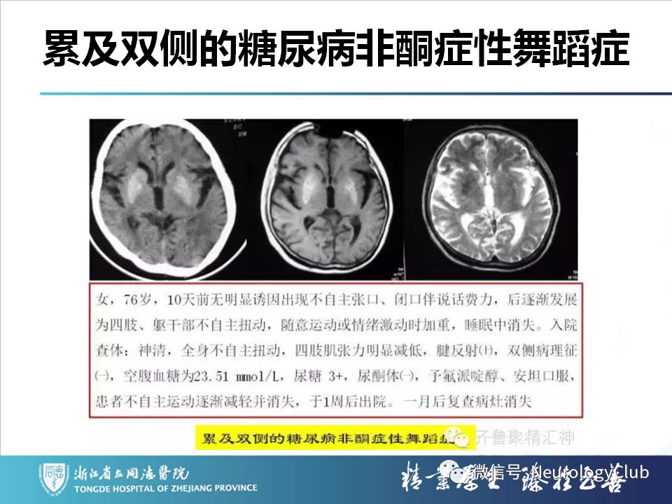 影像PPT - 【PPT】双侧基底节病变的影像诊断和鉴别诊断-51