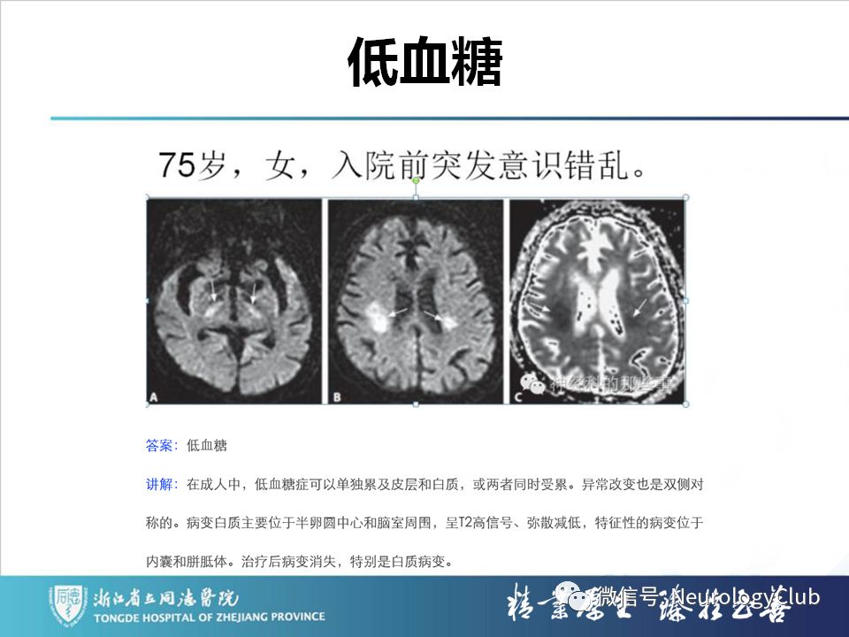 影像PPT - 【PPT】双侧基底节病变的影像诊断和鉴别诊断-54