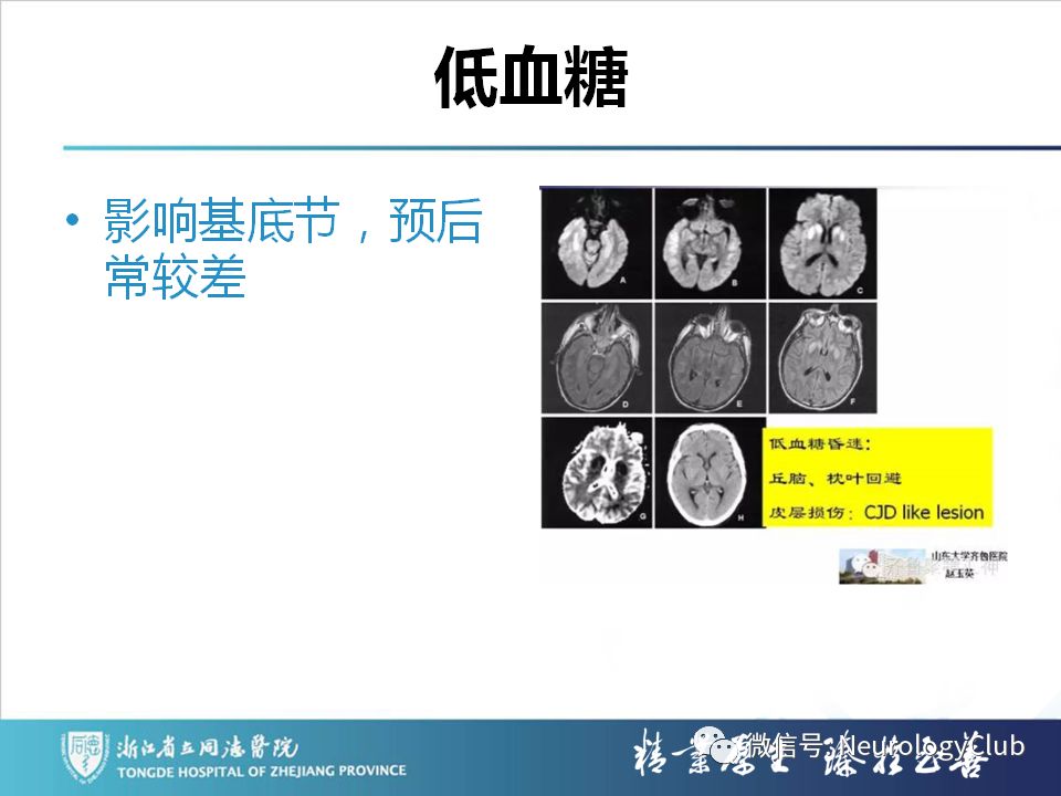 影像PPT - 【PPT】双侧基底节病变的影像诊断和鉴别诊断-53