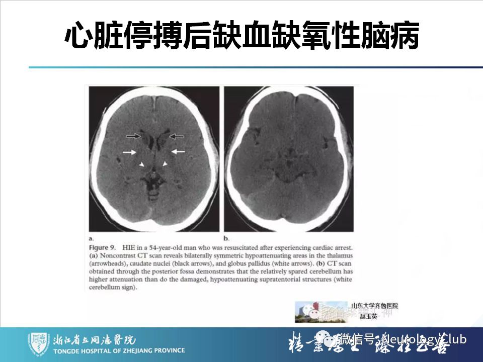 影像PPT - 【PPT】双侧基底节病变的影像诊断和鉴别诊断-57