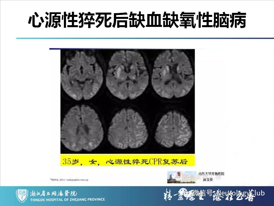 影像PPT - 【PPT】双侧基底节病变的影像诊断和鉴别诊断-58
