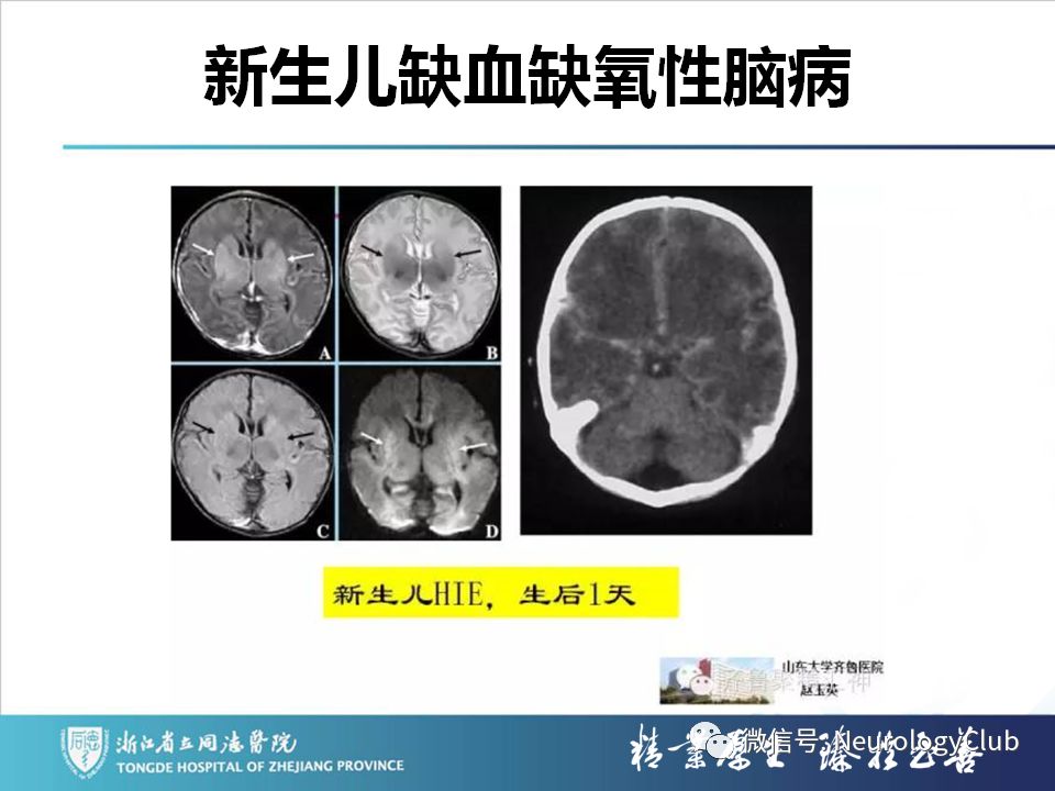 影像PPT - 【PPT】双侧基底节病变的影像诊断和鉴别诊断-59