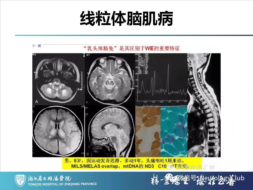 影像PPT - 【PPT】双侧基底节病变的影像诊断和鉴别诊断-62