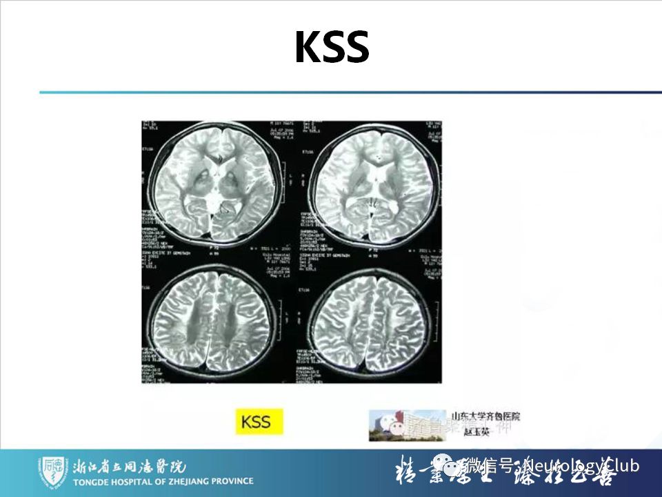 影像PPT - 【PPT】双侧基底节病变的影像诊断和鉴别诊断-64