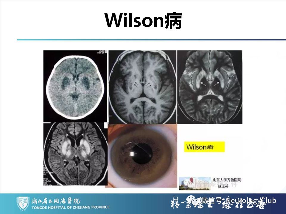 影像PPT - 【PPT】双侧基底节病变的影像诊断和鉴别诊断-67