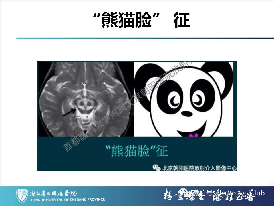 影像PPT - 【PPT】双侧基底节病变的影像诊断和鉴别诊断-68
