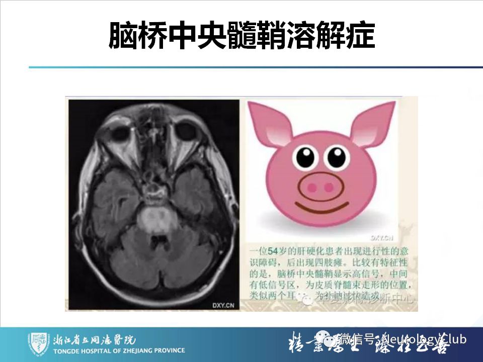影像PPT - 【PPT】双侧基底节病变的影像诊断和鉴别诊断-71