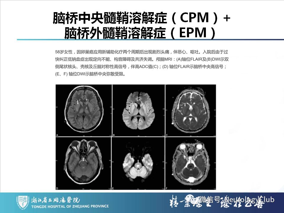 影像PPT - 【PPT】双侧基底节病变的影像诊断和鉴别诊断-72