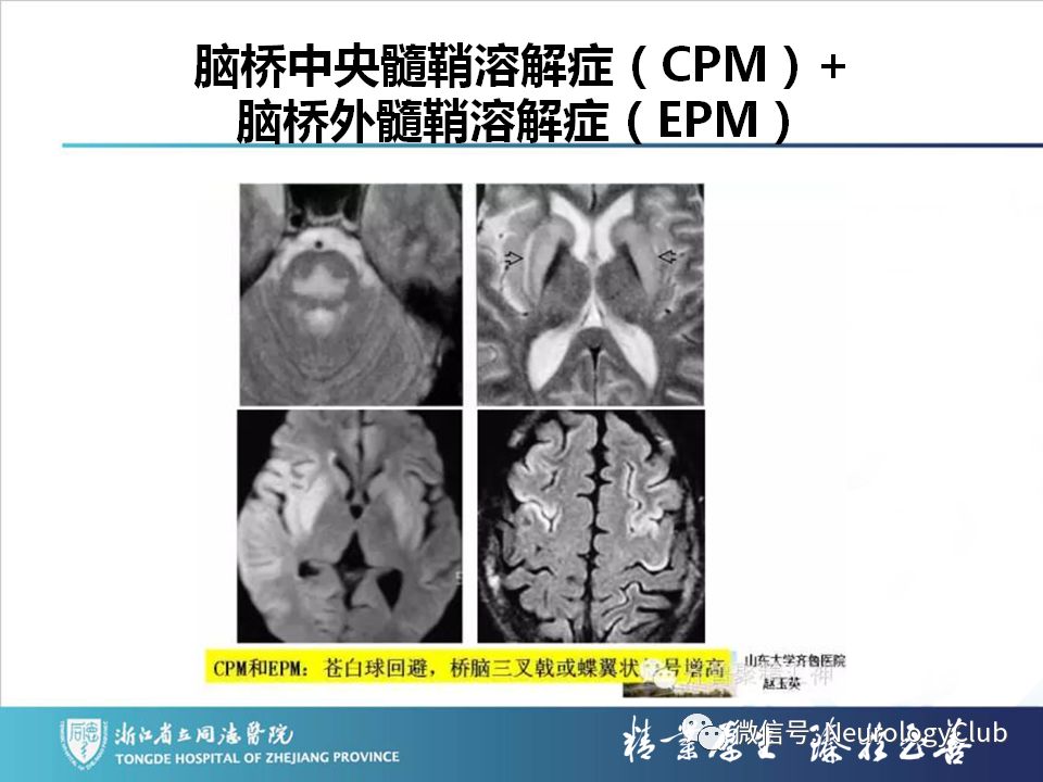 影像PPT - 【PPT】双侧基底节病变的影像诊断和鉴别诊断-73
