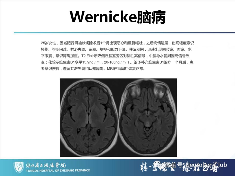 影像PPT - 【PPT】双侧基底节病变的影像诊断和鉴别诊断-76