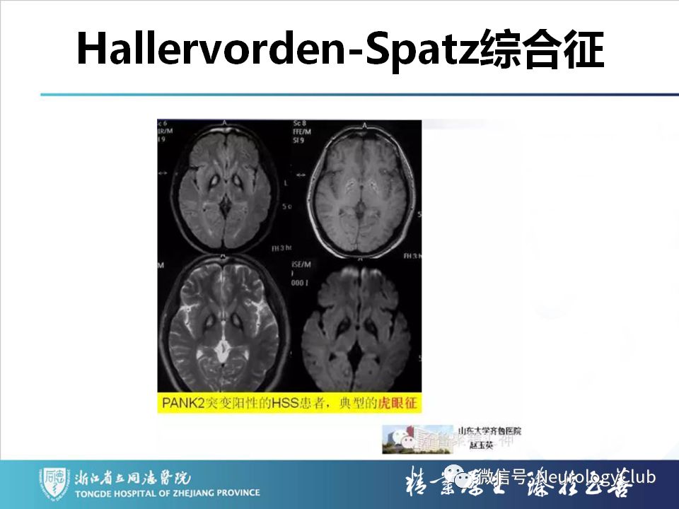 影像PPT - 【PPT】双侧基底节病变的影像诊断和鉴别诊断-80