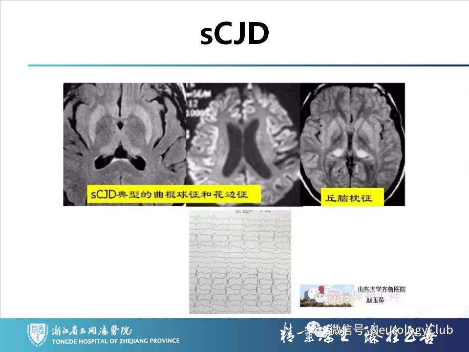 影像PPT - 【PPT】双侧基底节病变的影像诊断和鉴别诊断-83