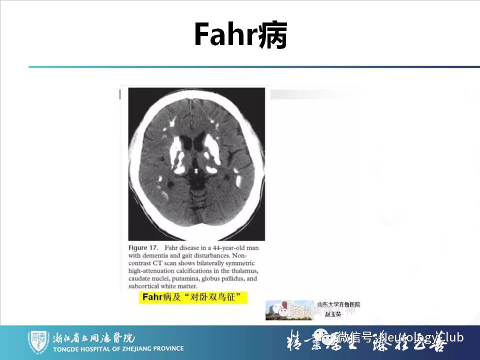影像PPT - 【PPT】双侧基底节病变的影像诊断和鉴别诊断-86