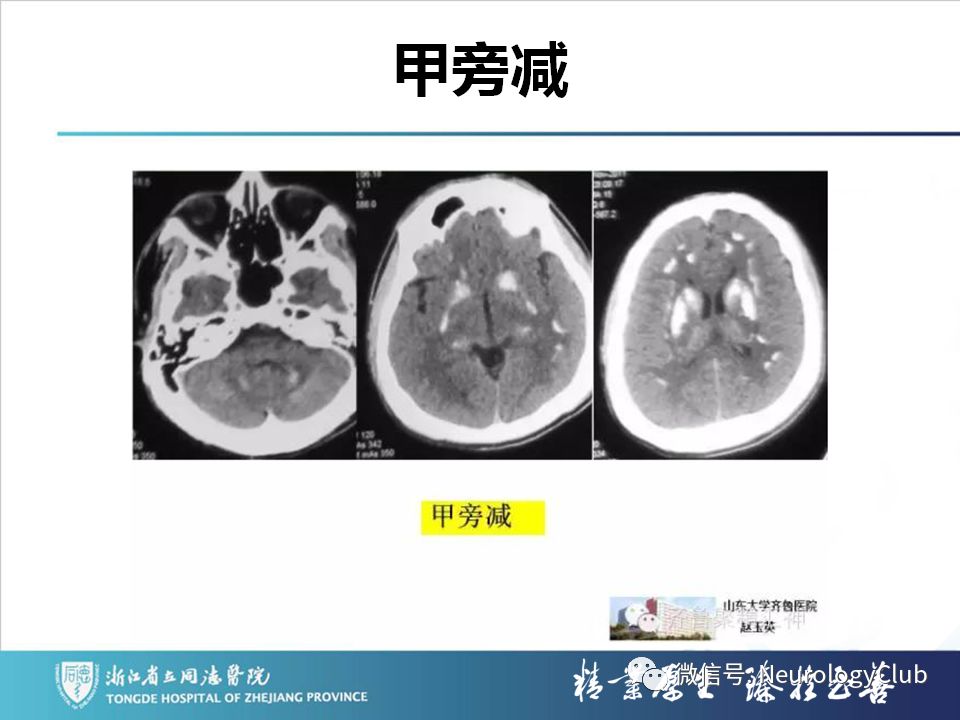 影像PPT - 【PPT】双侧基底节病变的影像诊断和鉴别诊断-87