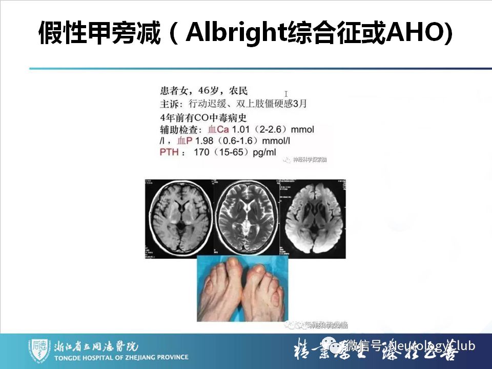 影像PPT - 【PPT】双侧基底节病变的影像诊断和鉴别诊断-88