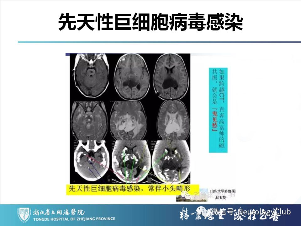 影像PPT - 【PPT】双侧基底节病变的影像诊断和鉴别诊断-91