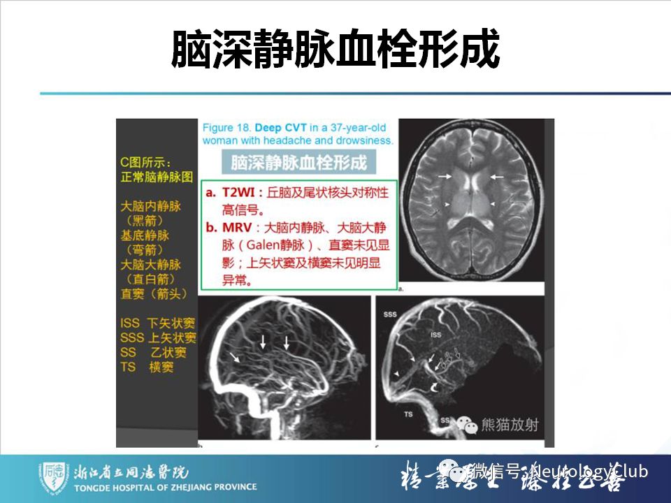 影像PPT - 【PPT】双侧基底节病变的影像诊断和鉴别诊断-102