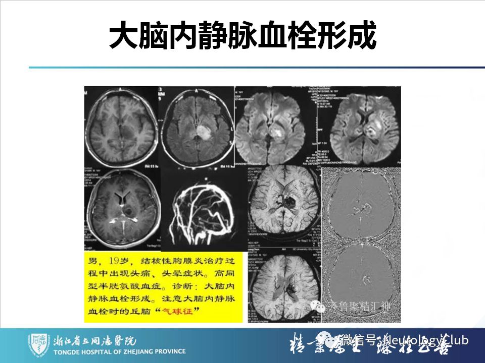影像PPT - 【PPT】双侧基底节病变的影像诊断和鉴别诊断-103