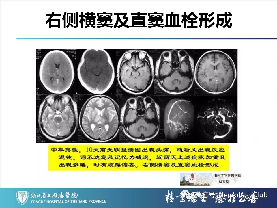 影像PPT - 【PPT】双侧基底节病变的影像诊断和鉴别诊断-108