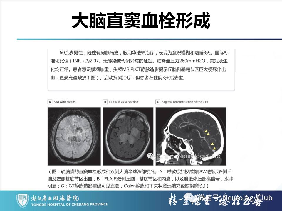影像PPT - 【PPT】双侧基底节病变的影像诊断和鉴别诊断-109