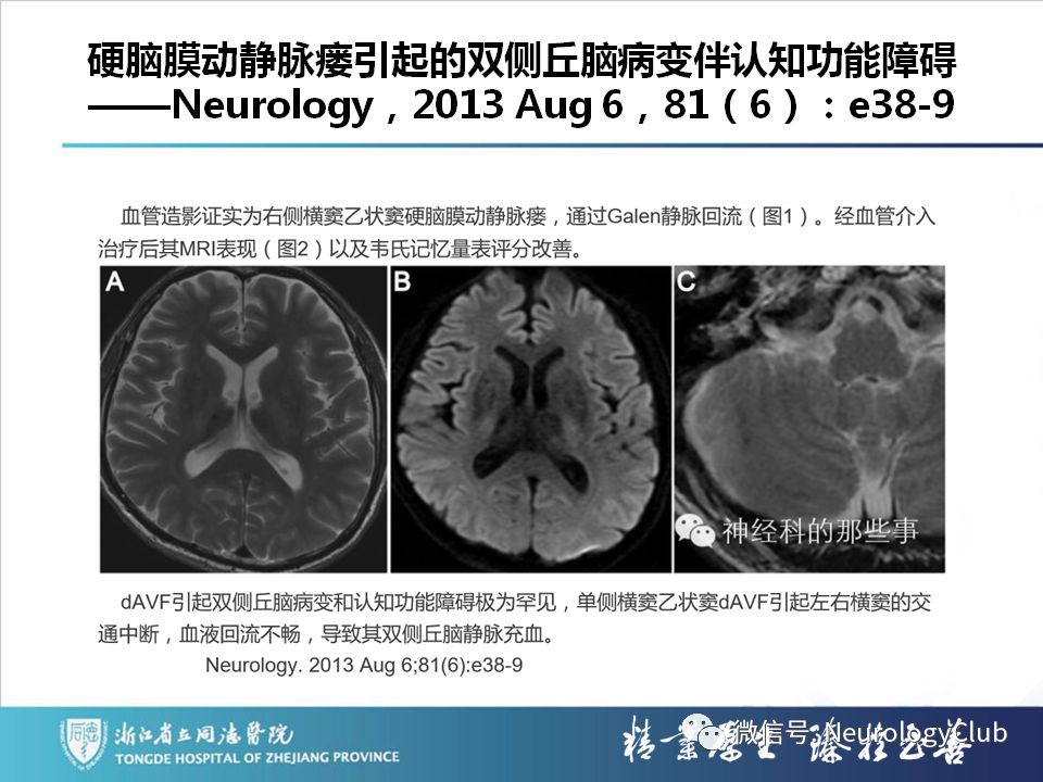 影像PPT - 【PPT】双侧基底节病变的影像诊断和鉴别诊断-111