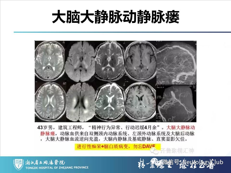 影像PPT - 【PPT】双侧基底节病变的影像诊断和鉴别诊断-112