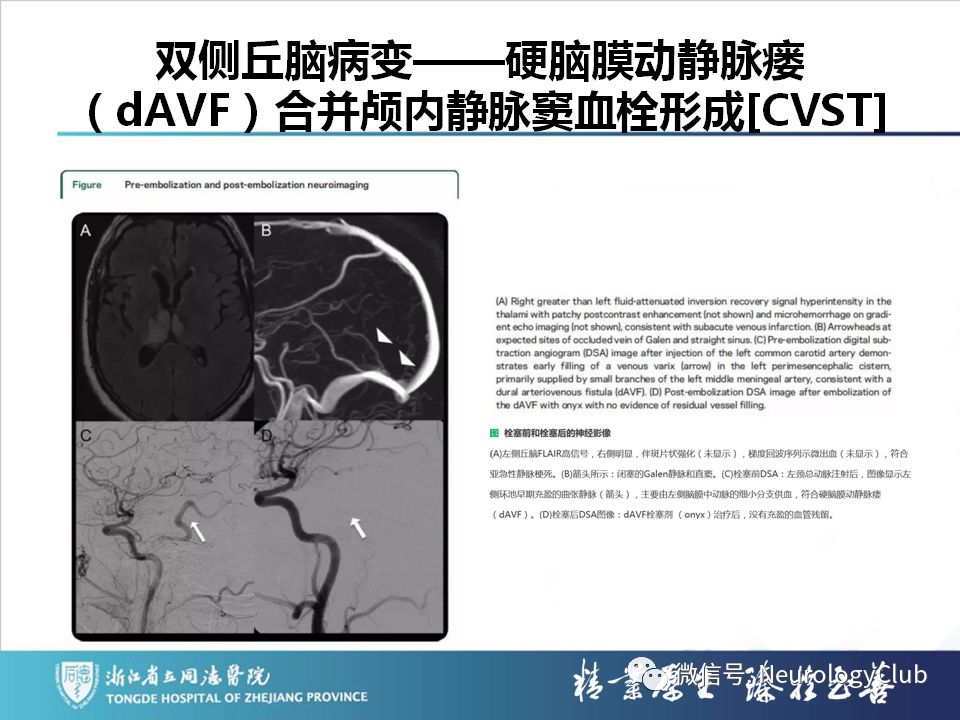 影像PPT - 【PPT】双侧基底节病变的影像诊断和鉴别诊断-113