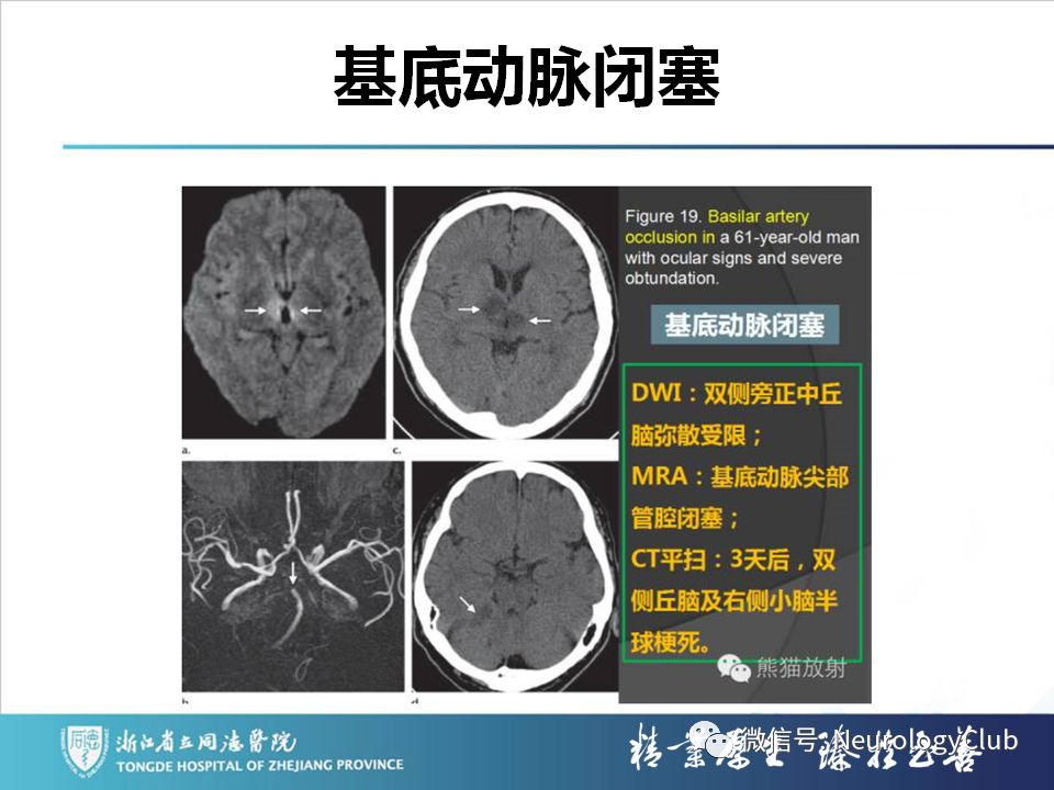 影像PPT - 【PPT】双侧基底节病变的影像诊断和鉴别诊断-115
