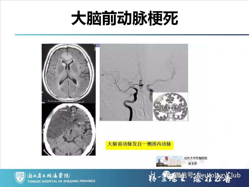 影像PPT - 【PPT】双侧基底节病变的影像诊断和鉴别诊断-123