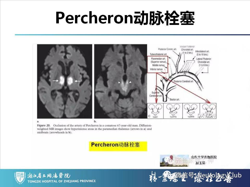 影像PPT - 【PPT】双侧基底节病变的影像诊断和鉴别诊断-122