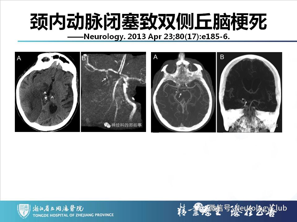 影像PPT - 【PPT】双侧基底节病变的影像诊断和鉴别诊断-124