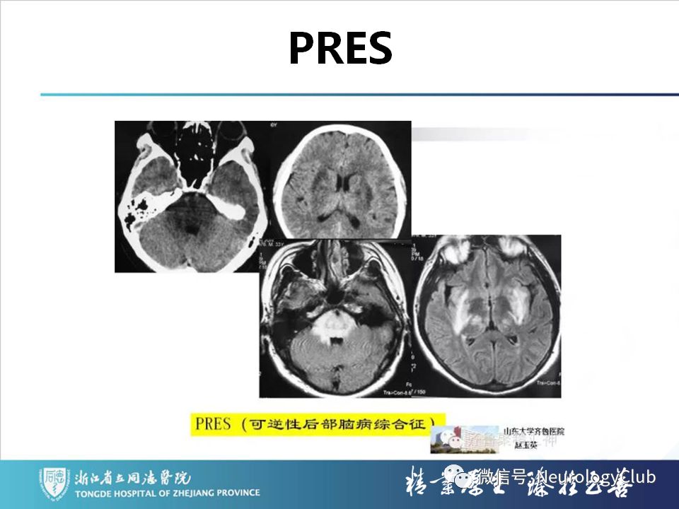 影像PPT - 【PPT】双侧基底节病变的影像诊断和鉴别诊断-125