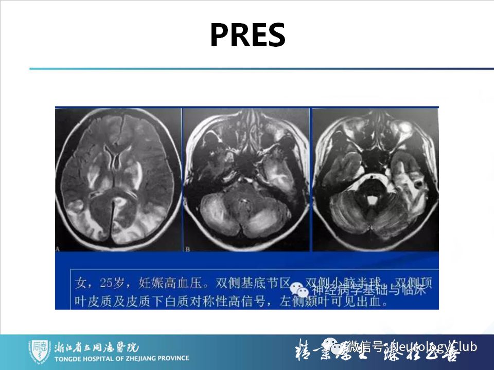 影像PPT - 【PPT】双侧基底节病变的影像诊断和鉴别诊断-126