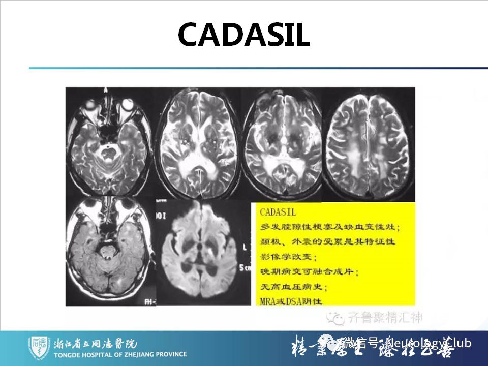 影像PPT - 【PPT】双侧基底节病变的影像诊断和鉴别诊断-129
