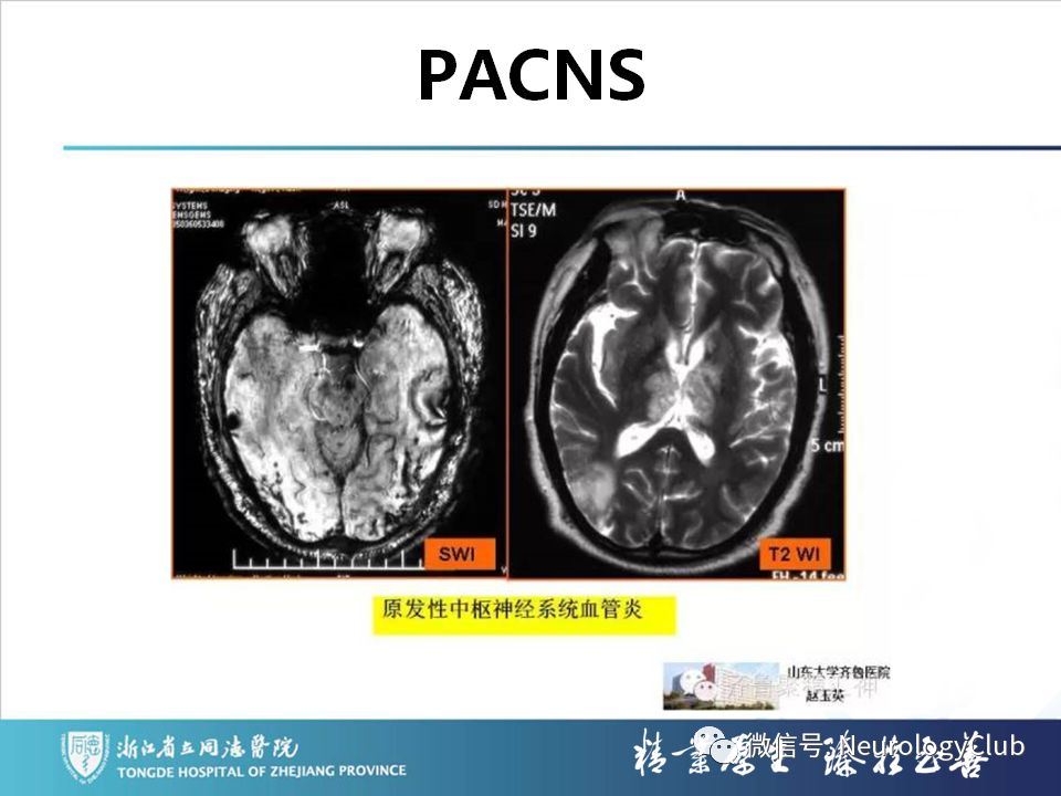 影像PPT - 【PPT】双侧基底节病变的影像诊断和鉴别诊断-128