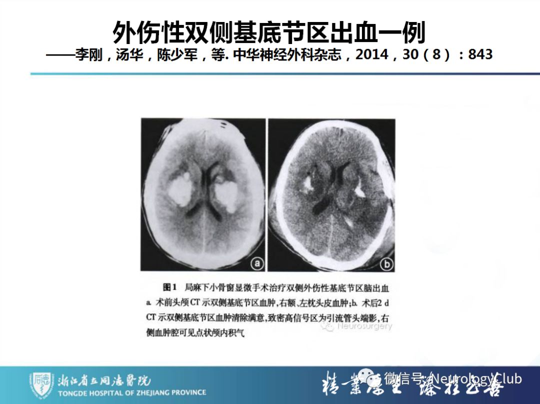 影像PPT - 【PPT】双侧基底节病变的影像诊断和鉴别诊断-132
