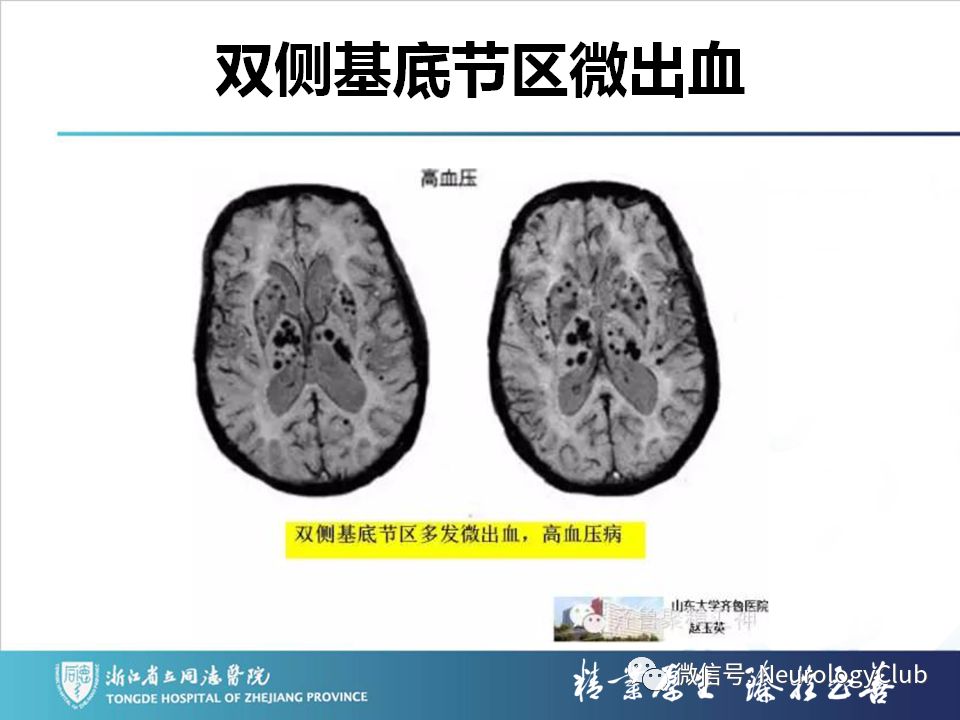 影像PPT - 【PPT】双侧基底节病变的影像诊断和鉴别诊断-133